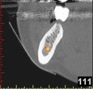 3D-Implantatplanung - Detailaufnahme 1