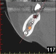 3D-Implantatplanung - Detailaufnahme 7