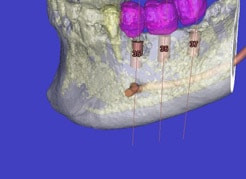 Transparente Darstellung des Kiefers mit Blick auf die Schraubimplantate